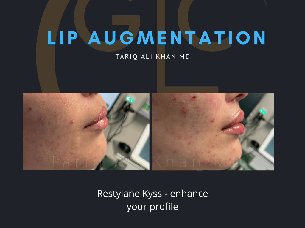 Gentle Care Laser Tustin & Long Beach Before and After picture - Lip Augmentation